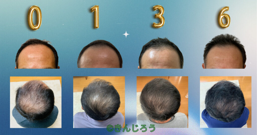 using-minoxidil-only-at-night-for-6- months