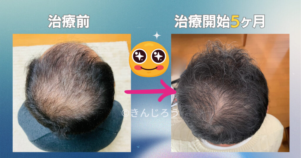 After-5-month-of-minoxidil-use-top